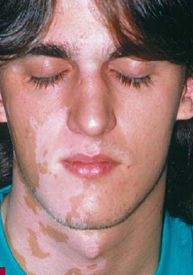 vitiligo arc